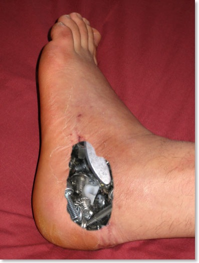 bionicfoot